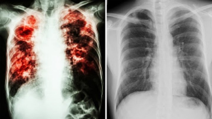10 міфів про туберкульоз